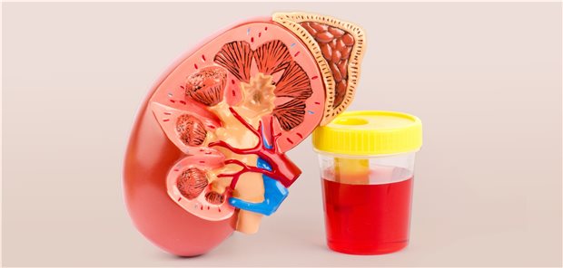 Blut im Urin: Eine mögliche Ursache könnte eine glomeruläre Dysfunktion sein, die eine sich entwickelnde Niereninsuffizienz andeutet.