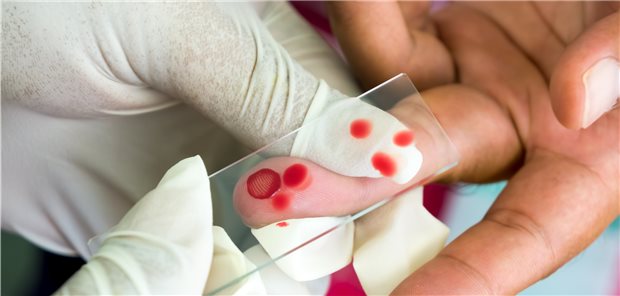 Blutausstrich: Die Malaria-Diagnose muss immer im „dicken Tropfen“ infektiologisch bestätigt werden.