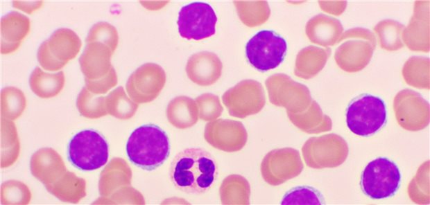 Blutausstrich bei AML.