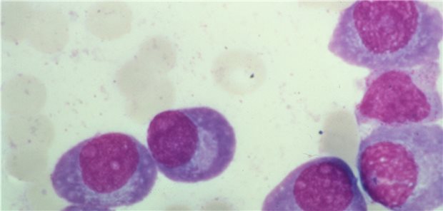 Blutausstrich bei Multiplem Myelom.