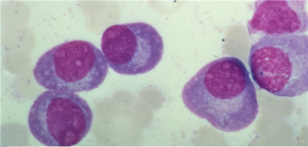Blutausstrich bei multiplem Myelom: Die Diagnose wird im primärärztlichen Bereich häufig verzögert gestellt.