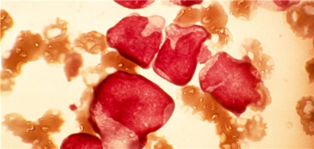 Blutausstrich eines Patienten mit akuter myeloischer Leukämie (AML) unter dem Mikroskop.