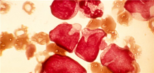 Blutausstrich eines Patienten mit akuter myeloischer Leukämie (AML) unter dem Mikroskop. Es gibt eine neue Therapieoption.