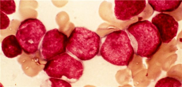 Blutausstrich eines Patienten mit akuter myeloischer Leukämie (AML). 