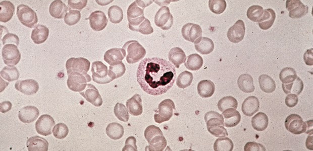 Die Hoffnung EPO verpufft Blutausstrich eines Patienten mit hypochromer Anämie.