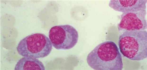 Blutaustrich bei Multiplem Myelom: Bei etwa jedem fünften Patienten ist während der Krebstherapie mit einer Infektion zu rechnen.