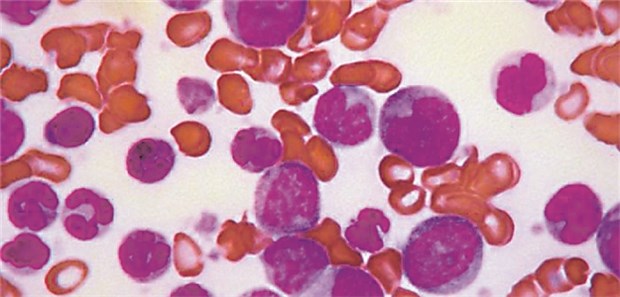 Neue Herausforderungen für Patienten mit chronisch myeloischer Leukämie Blutbild: Blastenkrise bei Chronisch-myeoloischer Leukämie (CML).
