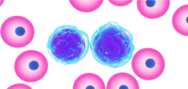 Blutbild bei chronisch lymphatischer Leukämie (CLL) im Modell: Typisch sind die pathologisch veränderten B-Lymphozyten (Mitte).