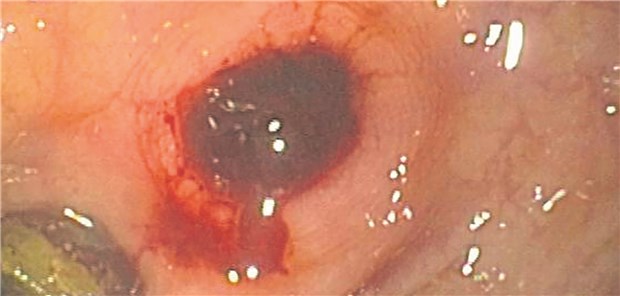 Blutendes Divertikel: Birgt Antikoagulation das Risiko für ein Rezidiv?