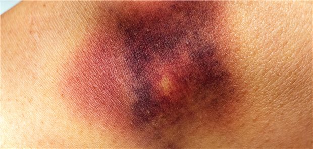 Bluter benötigen Vorsorge. Der dafür zugelassene Antikörper Emicizumab wird als Monotherapie gegeben.