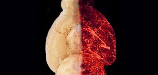Adipositas-bedingte Hypertonie: Neue Mechanismen entdeckt Blutgefäße im transparent erscheinenden Gehirn eines adipösen Mausmodells.