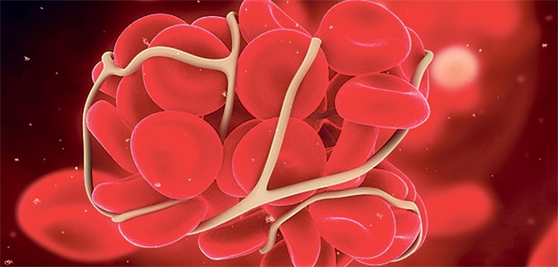 Gerinnungshemmer absetzen - ja oder nein? Blutgerinnsel – nicht immer ist das therapeutische Prozedere klar vorgegeben.