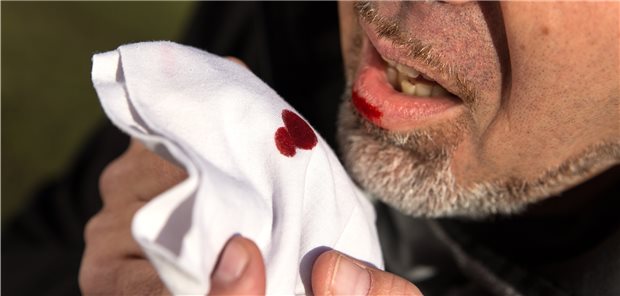 Bluthusten ist bei TB selten und Zeichen einer fortgeschrittenen offenen Tuberkulose.