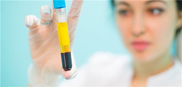 Risiko für Diabetes-Folgeleiden steigt mit erhöhtem NT-proBNP Blutplasma im Blick: NT-proBNP-Werte könnten für die Risikoüberwachung von Typ-2-Diabetes informativ sein.