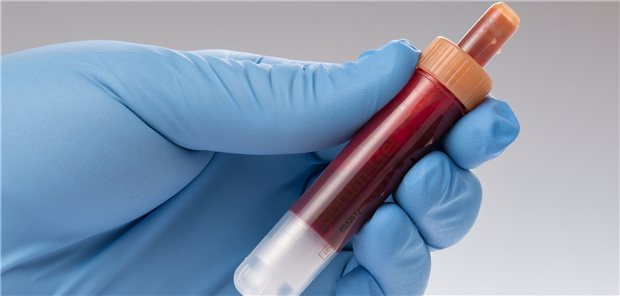 Blutprobe für den Troponin-Test: Hochsensitives Troponin I ist hilfreich bei der Identifizierung von COPD-Patienten, die ein erhöhtes Sterberisiko haben.