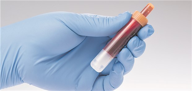 Blutprobe für einen Troponintest: In einer Studie war bei jedem achten Patienten ohne Infarkt-Symptome das kardiale Troponin erhöht.