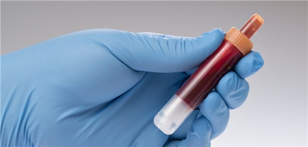 Blutprobe für einen Troponintest: Zum Ausschluss eines Myokardinfarktverdachts verlässlich, zur Positivdiagnose weniger gut geeignet.