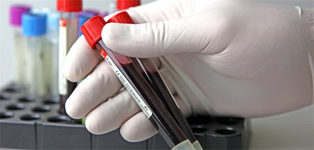 Blutprobe zur Analyse: Alte Patienten mit hohen Schwankungen der LDL-Werte hatten in der Studie deutliche kognitive Defizite.