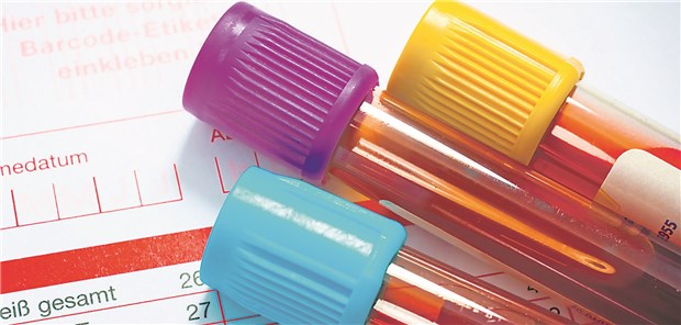 Blutproben zur Lipidbestimmung: Es gibt erneut einen Hinweis auf die Bedeutung des Cholesterinstoffwechsels bei Morbus Alzheimer.