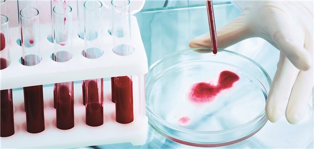 Bluttest: Chinesische Forscher haben einen Test entwickelt, der auf der Basis typischer DNA-Methylierungsmuster Krebserkrankungen bereits Jahre vor der Diagnose anhand von zirkulierender Tumor-DNA im Blutplasma erkennen soll.