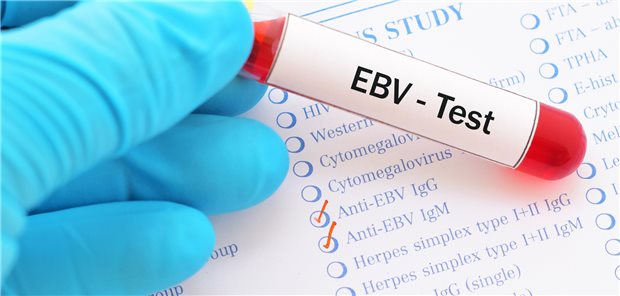 Bluttest auf EBV: Rund 95 Prozent aller Menschen infizieren sich im Laufe ihres Lebens mit dem Virus.
