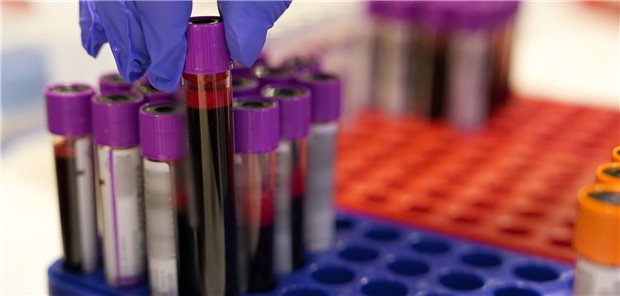 Blutuntersuchungen sind in der Regel einfach durchzuführen. In einer Studie wurde nun ein Bluttest für einen weiteren Alzheimer-Biomarker geprüft.