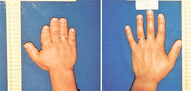 Gen für Hypertonie plus Kurzfingrigkeit entdeckt Brachydaktylie und Hypertonie - Merkmale einer seltenen Erbkrankheit. Die Hand einer Betroffenen (li.) im Vergleich zu der einer Gesunden.