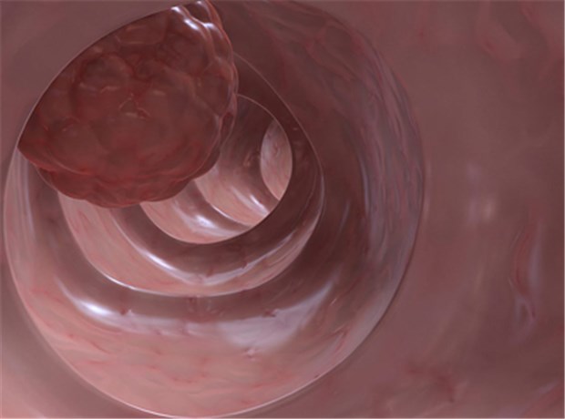 Genauigkeit - Schlüssel zur guten Koloskopie Breitbasiger Polyp im Dickdarm © Sebastian Kaulitzki / fotolia.com