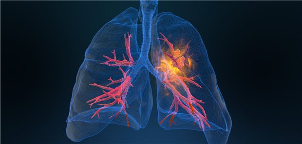 Bronchial-Ca: Jetzt gibt es eine Therapieoption mehr.