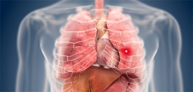 Vernetzung macht's möglich Bronchialkarzinome sind die häufigste Krebstodesursache in Deutschland: Jährlich sterben daran circa 45.000 Patienten.