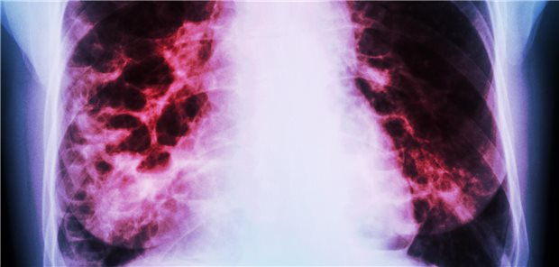 Bronchiektasien: Die Sputumfarbe ist prognoserelevant Bronchiektasien im eingefärbten Röntgenbefund. Welche Konsequenzen sind aus der Farbe des Sputums zu ziehen?