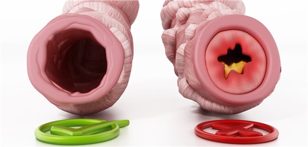 Bronchien ohne und mit Obstruktion: Die Therapie mit Tezepelumab kommt für ein breites Patientenspektrum mit unkontrolliertem schwerem Asthma infrage.