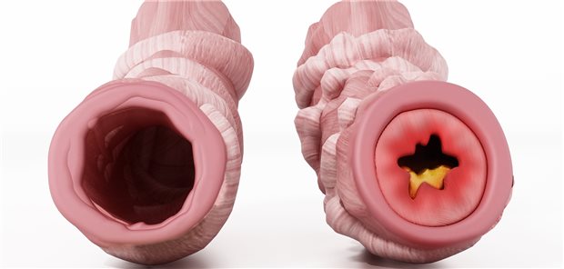 Bronchus mit Obstruktion bei Asthma.