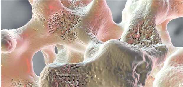 Knochenstruktur bei Osteoporose