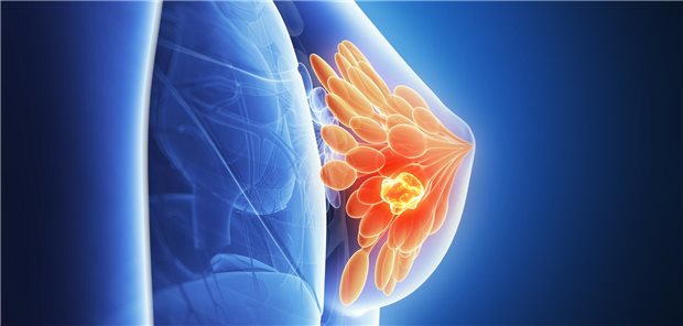 Grafische Darstellung Brustkrebs