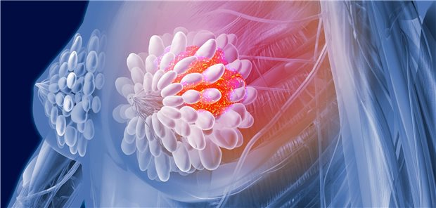 Brustkrebs. Auch für diese Krebspatienten werden neue Wirkstoffe und neue Therapieregimes entwickelt. Dazu gehört der PARP-Inhibitor Talazoparib.