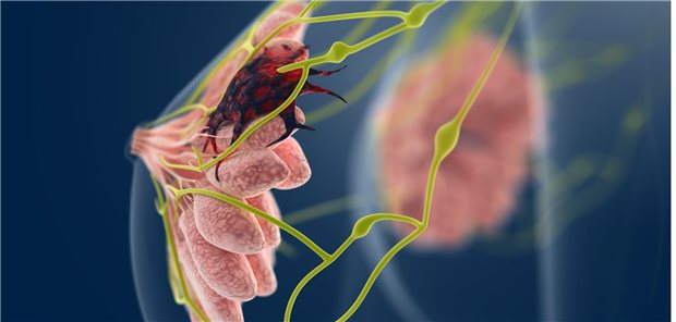 Brustkrebs: Auch hier wird intensiv nach neuen Therapieoptionen gesucht.