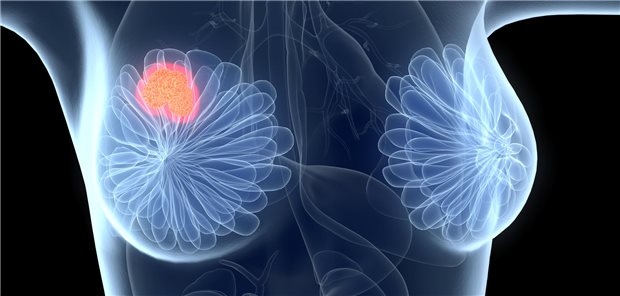 Brustkrebs-Befunde fehlerhaft interpretiert - das soll einer Ärztin am Klinikum Bremen passiert sein.