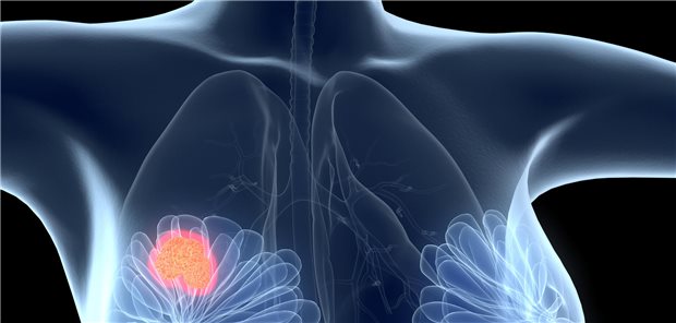 Brustkrebs-Befunde fehlerhaft interpretiert – das soll einer Ärztin am Klinikum Bremen passiert sein.