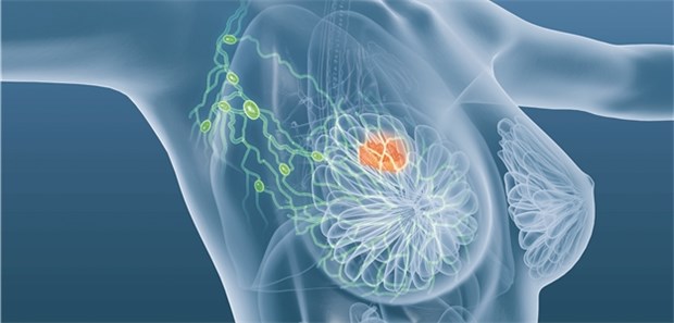 Mamma-Ca – Abemaciclib plus Fulvestrant ein gutes Gespann Brustkrebs – Bei Hormontherapieresistenz kann eine Kombi mit einem CDK4/6-Inhibitor helfen.