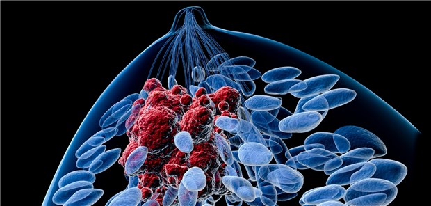 Brustkrebs: Bei der Versorgung von Patientinnen mit tripelnegativem Mammakarzinom lässt sich im OPAL-Register kein klarer Trend erkennen.