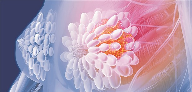 Brustkrebs: Die Inzidenz von Hirnmetastasen steigt.