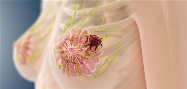 Brustkrebs: Die bessere Prognose nach brusterhaltender Therapie im Vergleich zur Mastektomie zeigte sich in einer US-amerikanischen Studie unabhängig von Tumortyp, Alter der Patientin, Tumorgröße und Zahl der betroffenen Lymphknoten.