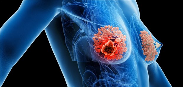 Die Autorinnen und Autoren resümieren, dass bei der Rate der Brustkrebsrezidive die Veränderungen der Patientinnen- und Tumorcharakteristika sowie die Therapiefortschritte mit 80,5 Prozent bei den ER-positiven und mit 89,8 Prozent bei den ER-negativen Teilnehmerinnen zu Buche geschlagen hat.