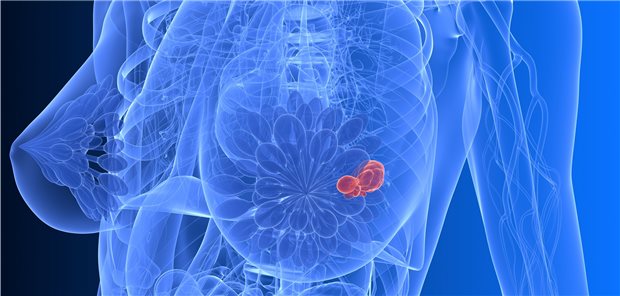 Brustkrebs: Mit einer weiterentwickelten Mammographie-Technik wurden in einer Studie deutlich mehr invasive Mammakarzinome entdeckt als mit der Standardmethode.