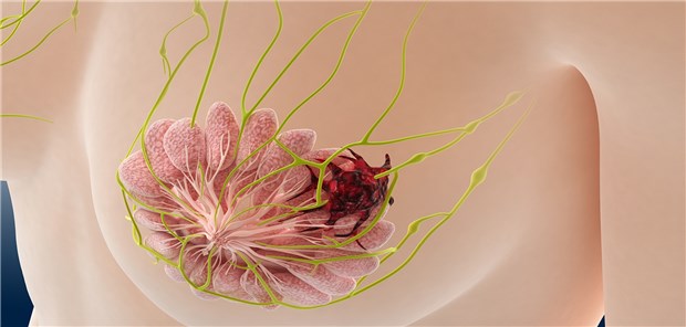 Brustkrebs! Neue Wirkstoffe wie die CDK4/6-Inhibitoren erweitern die Optionen einer maßgeschneiderten Behandlung.