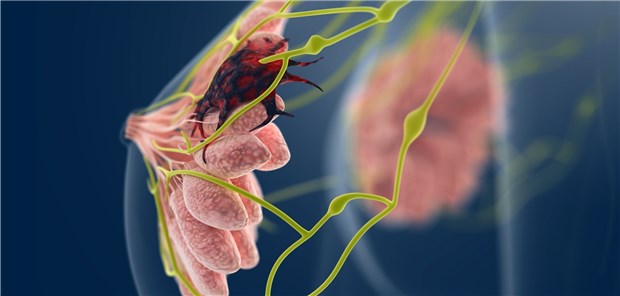 Beim lokoregionären Mammakarzinom sind Schnittränder passé Brustkrebs – Was ist derzeit State-of-the-art bei lokoregionärer Therapie?