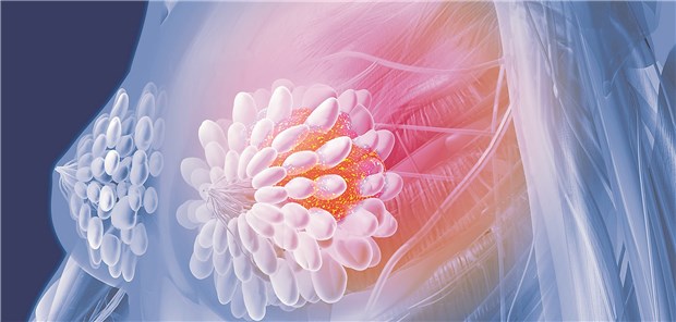 Brustkrebs: Welche Therapie ist individuell jeweils die beste?