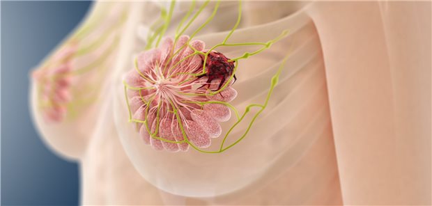 Brustkrebs! Welche Therapie ist möglich, gibt es Alternativen? Eine neue Fixdosiskombi ergänzt jetzt die Therapieoptionen.