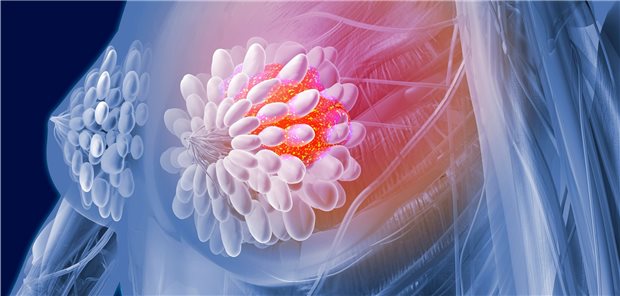 Brustkrebs in der Postmenopause: Auch vielen nodal-positiven Frauen könnte die Chemo künftig erspart werden.